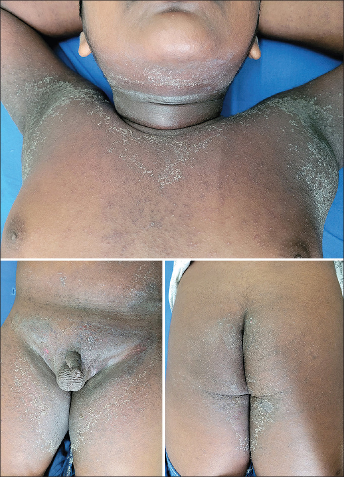 Symmetric drug-related intertriginous and flexural exanthema due to super-bioavailable itraconazole.