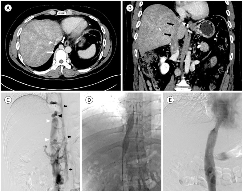 Inferior Vena Cava Stenosis Following Orthotopic Liver Transplantation: Differentiating Points from False Positives.