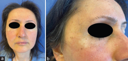 Photoallergic dermatitis and vitiligo-like lesion in a patient with metastatic breast cancer using ribociclib.