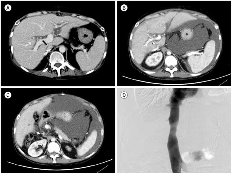 Inferior Vena Cava Stenosis Following Orthotopic Liver Transplantation: Differentiating Points from False Positives.