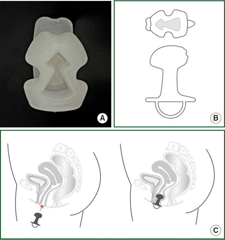 A Novel Incisionless Disposable Vaginal Device for Female Stress Urinary Incontinence: Efficacy and Quality of Life.