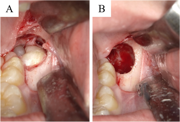 Kissing molars class III detected at a young age.