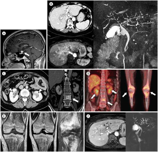 Erdheim-Chester Disease Involving the Biliary System and Mimicking Immunoglobulin G4-Related Disease: A Case Report.