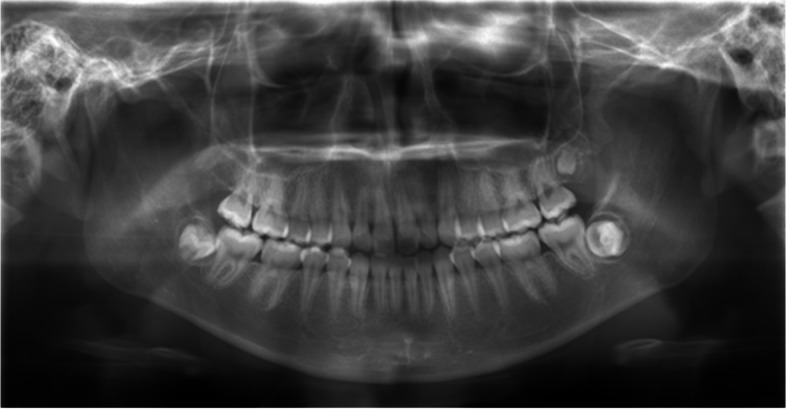 Kissing molars class III detected at a young age.