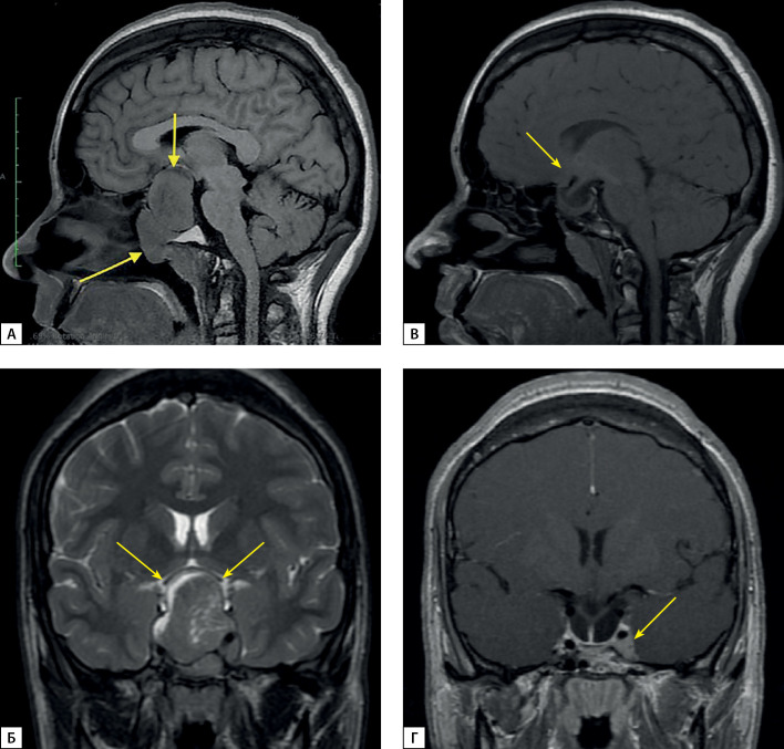 [Acromegaly in the differential diagnosis of hearing loss].