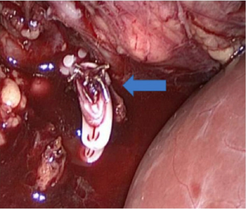 Wunderlich syndrome secondary to ureteropelvic junction obstruction.