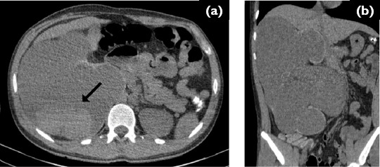 Wunderlich syndrome secondary to ureteropelvic junction obstruction.