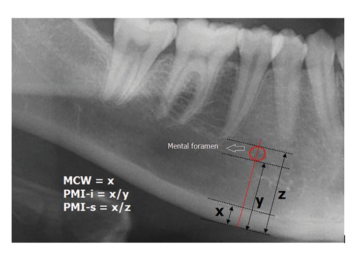 Evaluation of jaw bone changes in patients with asthma using inhaled corticosteroids with mandibular radiomorphometric indices on dental panoramic radiographs.