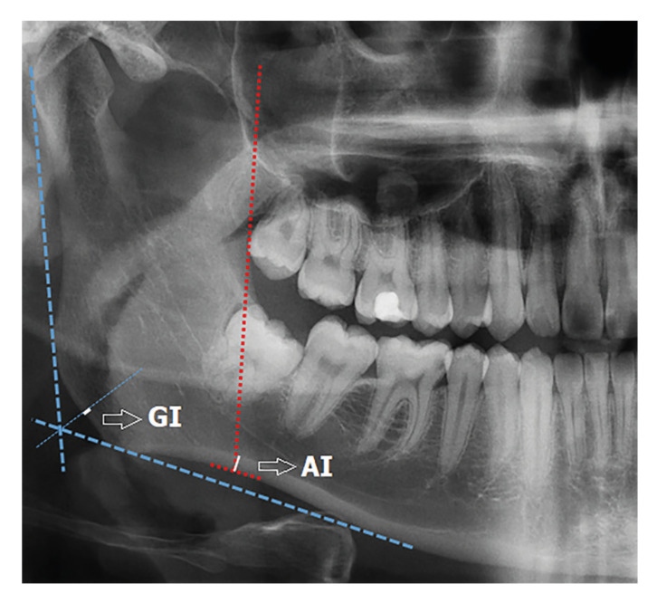 Evaluation of jaw bone changes in patients with asthma using inhaled corticosteroids with mandibular radiomorphometric indices on dental panoramic radiographs.