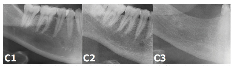 Evaluation of jaw bone changes in patients with asthma using inhaled corticosteroids with mandibular radiomorphometric indices on dental panoramic radiographs.