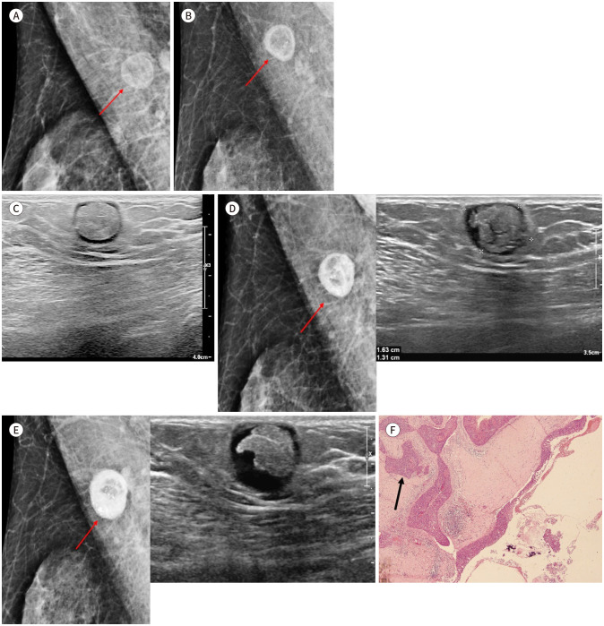 Squamous Cell Carcinoma Arising from Epidermal Inclusion Cyst of Breast: Imaging Findings and Literature Review.