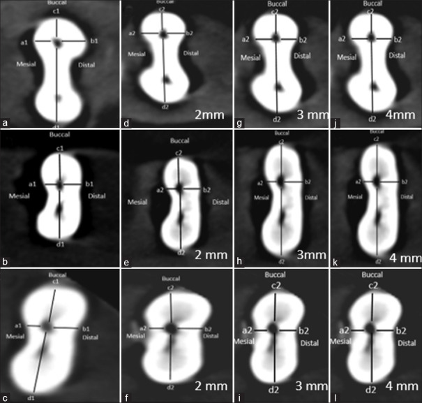 Comparative evaluation of canal transportation and centering ability of rotary and reciprocating file systems using cone-beam computed tomography: An <i>in vitro</i> study.