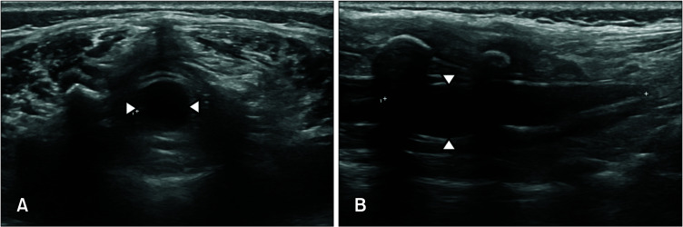 A Case of Perineal Hemangioma, External Genitalia Malformations, Lipomyelomeningocele, Vesicorenal Abnormalities, Imperforate Anus, and Skin Tag (PELVIS) Syndrome with Extensive Perineal Infantile Hemangioma.