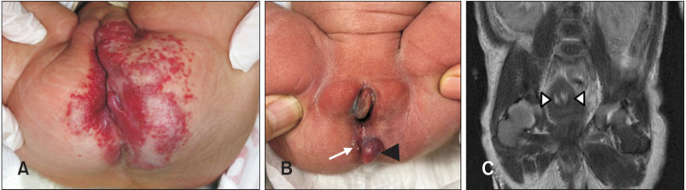 A Case of Perineal Hemangioma, External Genitalia Malformations, Lipomyelomeningocele, Vesicorenal Abnormalities, Imperforate Anus, and Skin Tag (PELVIS) Syndrome with Extensive Perineal Infantile Hemangioma.