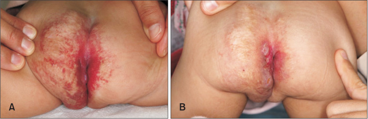 A Case of Perineal Hemangioma, External Genitalia Malformations, Lipomyelomeningocele, Vesicorenal Abnormalities, Imperforate Anus, and Skin Tag (PELVIS) Syndrome with Extensive Perineal Infantile Hemangioma.