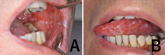 A case of severe oral mucosal GVHD induced by heterologous SARS-CoV-2 vaccination after cord blood transplantation.