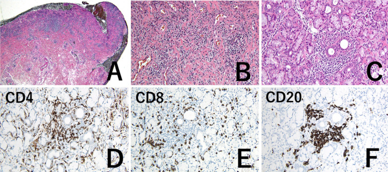 A case of severe oral mucosal GVHD induced by heterologous SARS-CoV-2 vaccination after cord blood transplantation.