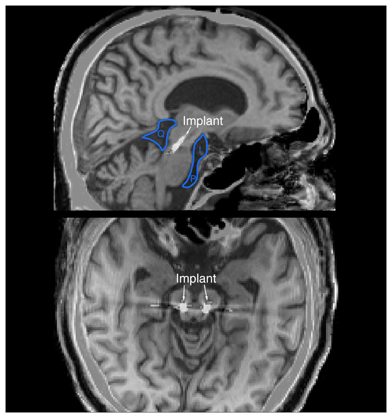 The Design of Brainstem Interfaces: Characterisation of Physiological Artefacts and Implications for Closed-loop Algorithms.