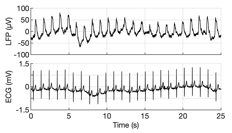 The Design of Brainstem Interfaces: Characterisation of Physiological Artefacts and Implications for Closed-loop Algorithms.