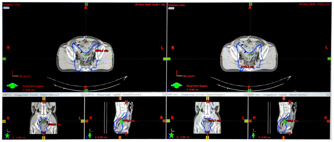 Reduction of the skin‑effect dose of IMRT plan for patients with cancer in pelvic region.