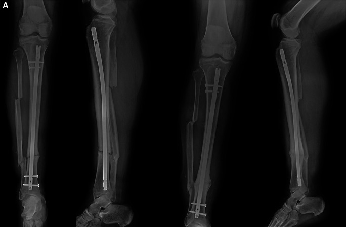 The Cambridge Experience with Lower Limb Long Bone Non-union Following Fixation and the Treatment Algorithm.