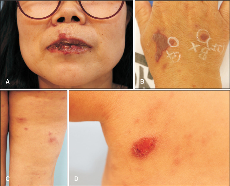 Stevens-Johnson Syndrome Following ChAdOx1 nCoV-19 Vaccination (AstraZeneca).