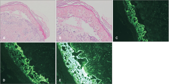 Stevens-Johnson Syndrome Following ChAdOx1 nCoV-19 Vaccination (AstraZeneca).