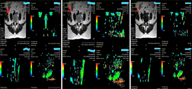 A Prospective Study to Evaluate the Clinical and Diffusion Tensor Imaging (DTI) Correlation in Patients with Lumbar Disc Herniation with Radiculopathy.