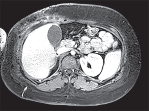 Unusual Manifestation of Extraosseous Ewing Sarcoma: Report of 3 Cases.