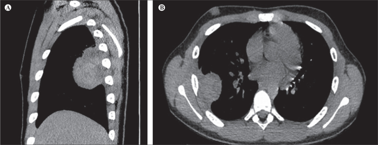 Unusual Manifestation of Extraosseous Ewing Sarcoma: Report of 3 Cases.