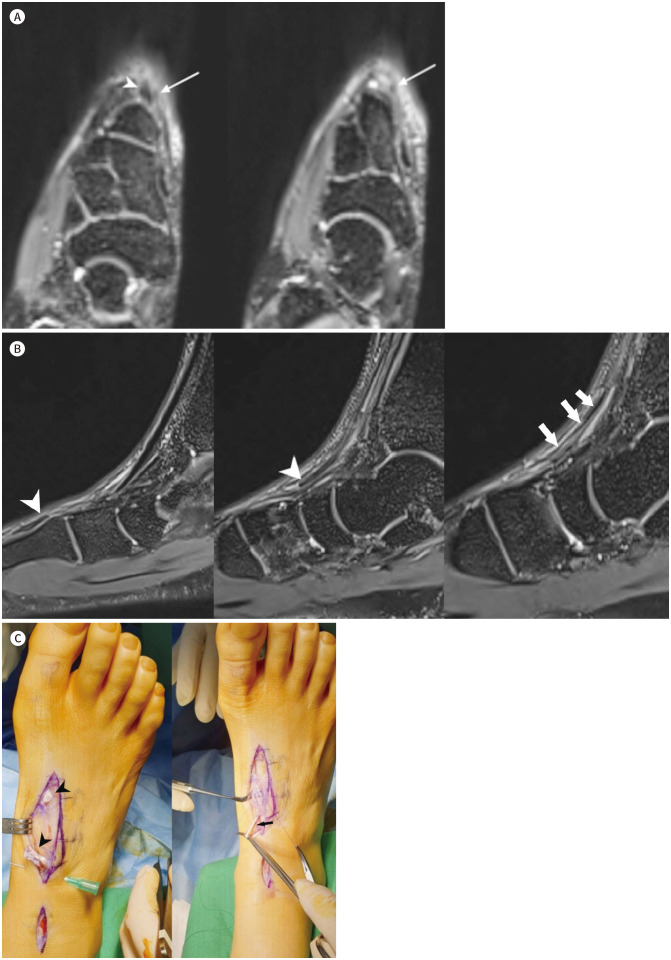 [Complete Rupture of the Extensor Hallucis Longus Tendon with Accessory Slip Mimicking a Partial Rupture: A Case Report].