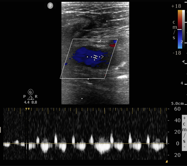 Femoral vein pulsatility: a simple tool for venous congestion assessment.