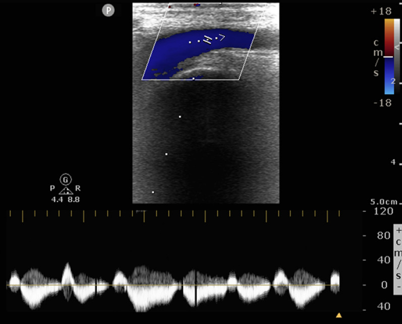 Femoral vein pulsatility: a simple tool for venous congestion assessment.