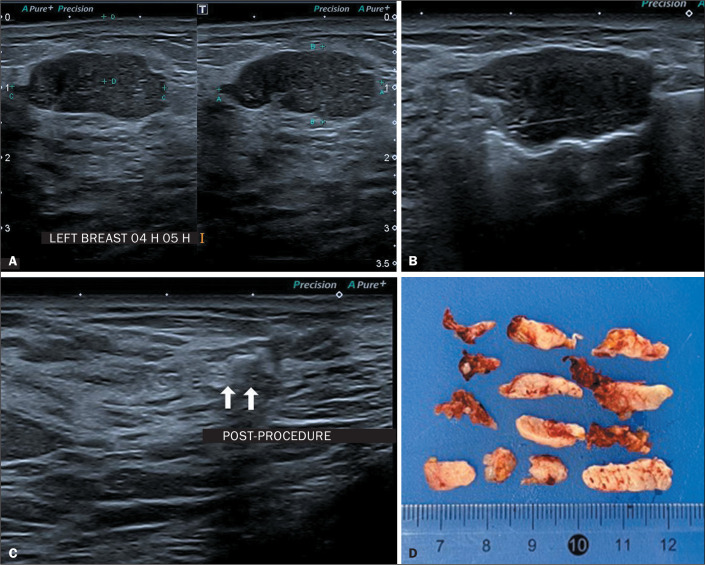 Vacuum-assisted excision of breast lesions in surgical de-escalation: where are we?