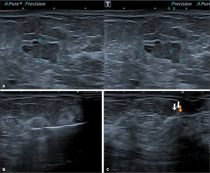 Vacuum-assisted excision of breast lesions in surgical de-escalation: where are we?