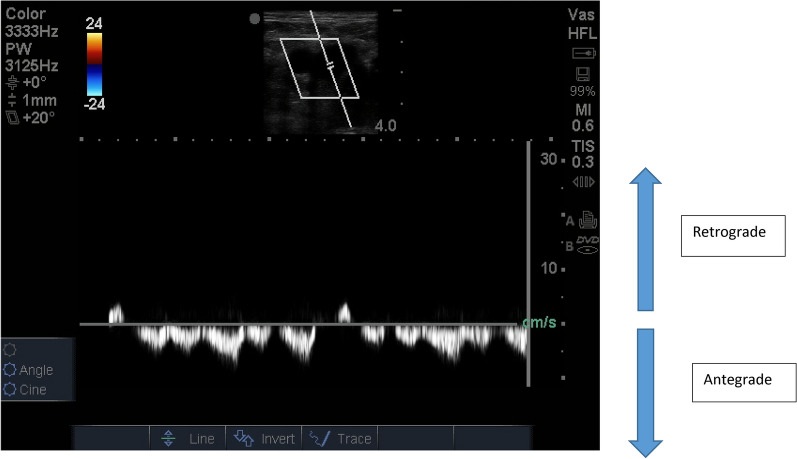 Femoral vein pulsatility: a simple tool for venous congestion assessment.