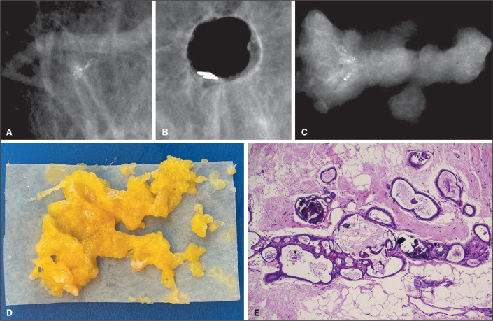 Vacuum-assisted excision of breast lesions in surgical de-escalation: where are we?