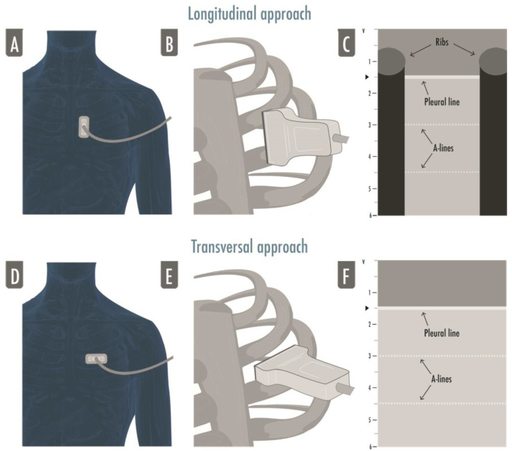 Lung Ultrasound in Critical Care and Emergency Medicine: Clinical Review.