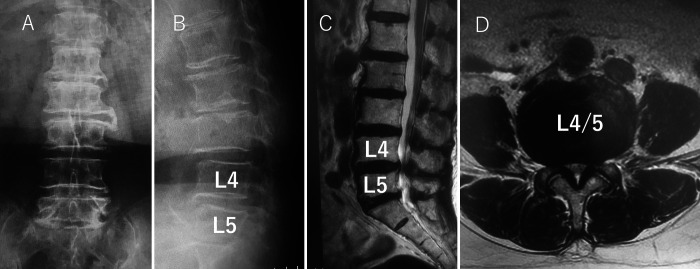 Contralateral lower limb radiculopathy by extraforaminal disc herniation following oblique lumbar interbody fusion in degenerative lumbar disorder: illustrative cases.