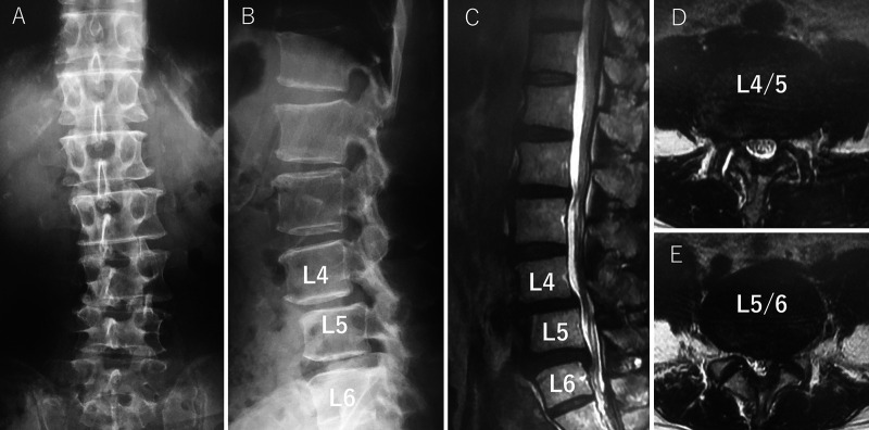 Contralateral lower limb radiculopathy by extraforaminal disc herniation following oblique lumbar interbody fusion in degenerative lumbar disorder: illustrative cases.