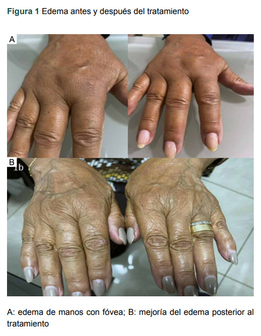 [Remitting seronegative symetrical synovitis with pitting edema. One case report].