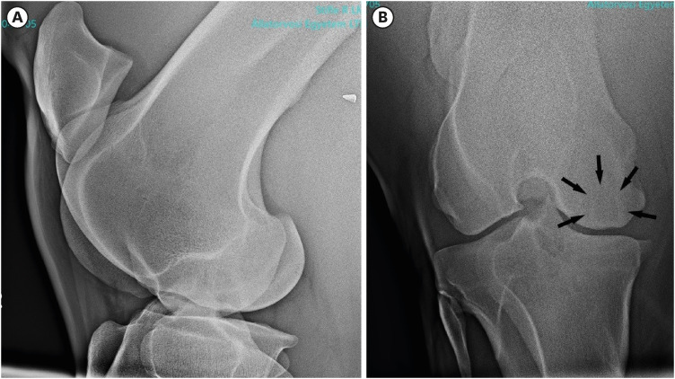 Osteochondral allograft transplantation for treating medial femoral condyle subchondral bone cyst in a 14-year-old standardbred horse: a case report.