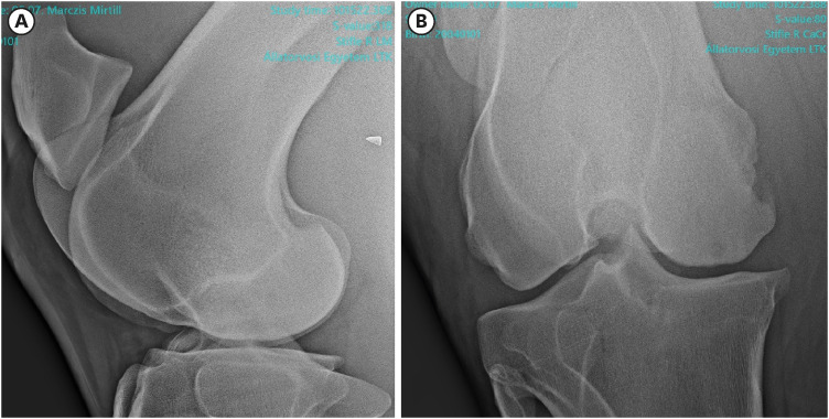 Osteochondral allograft transplantation for treating medial femoral condyle subchondral bone cyst in a 14-year-old standardbred horse: a case report.