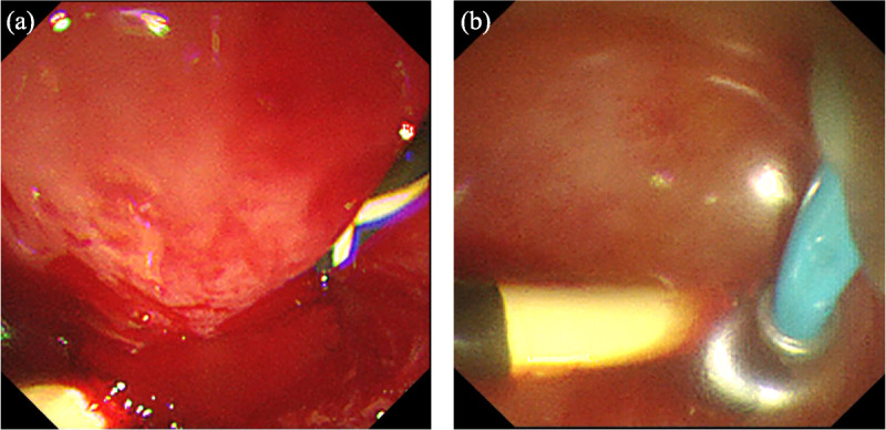 Rescue technique for bleeding after placement of plastic stent in EUS-guided hepaticogastrostomy (with videos).