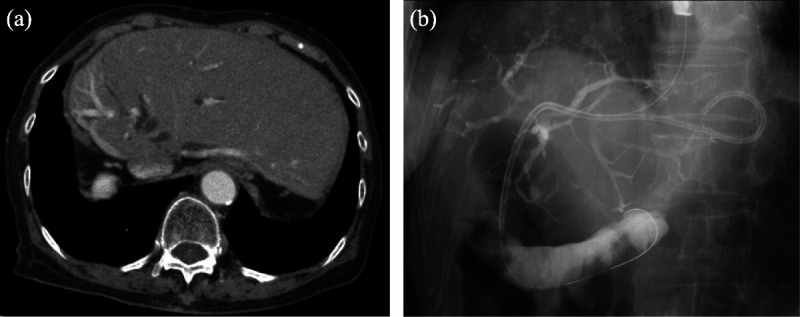 Rescue technique for bleeding after placement of plastic stent in EUS-guided hepaticogastrostomy (with videos).