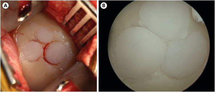 Osteochondral allograft transplantation for treating medial femoral condyle subchondral bone cyst in a 14-year-old standardbred horse: a case report.