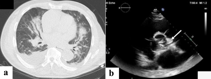 Native Mitral Valve Endocarditis Caused by a Non-HACEK Gram-Negative Pathogen in a Hemodialysis Patient.