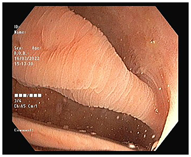 Aurora rings may not always indicate an inverted colonic diverticulum: Report of a rare case of colonic lipoma.