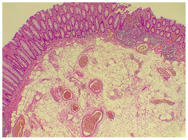 Aurora rings may not always indicate an inverted colonic diverticulum: Report of a rare case of colonic lipoma.