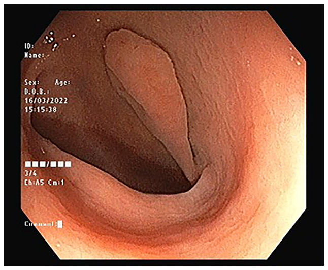 Aurora rings may not always indicate an inverted colonic diverticulum: Report of a rare case of colonic lipoma.